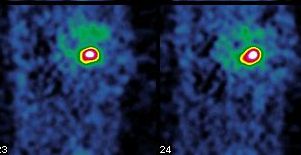 Obr. 4. SPECT dutiny hrudn, sagitln ezy se zamenm na primrn loisko neuroendokrinnho karcinomu v pankreatu.