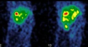 Obr. 5. SPECT dutiny bin, transverzln ezy se zamenm na drobn metastzy neuroendokrinnho karcinomu v jtrech.