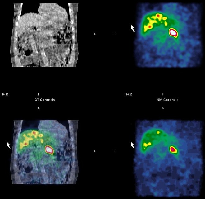 Obr. 8. SPECT, CT a SPECT dutiny bin, koronrn ezy