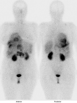 Obr. . 1: Celotlov scintigrafie v pedn a zadn projekci 4 hod. po aplikaci OctreoScanu