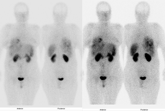 Obr. . 3: Celotlov scintigrafie v pedn a zadn projekci 4 hod. po aplikaci OctreoScanu