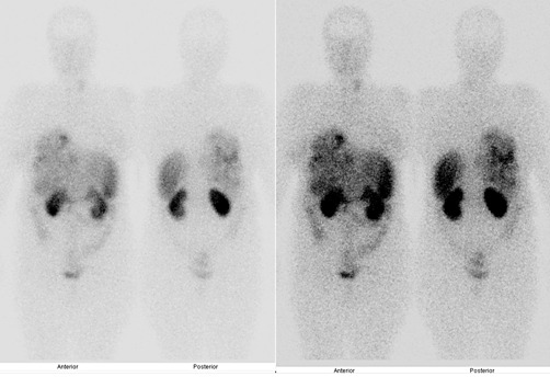Obr. . 4: Celotlov scintigrafie v pedn a zadn projekci 24 hod. po aplikaci OctreoScanu