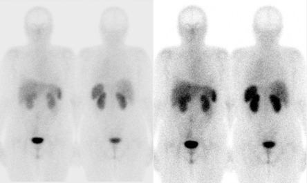 Obr. . 4: Celotlov scintigrafie v pedn a zadn projekci 4 hod. po aplikaci OctreoScanu