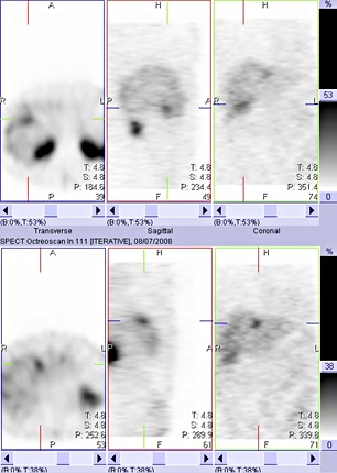 Obr. . 5: Tomografick scintigrafie jater 4 hod. po aplikaci OctreoScanu.