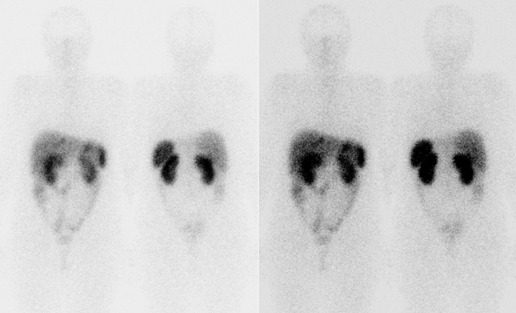 Obr. . 6: Celotlov scintigrafie v pedn a zadn projekci 24 hod. po aplikaci OctreoScanu