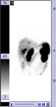 Obr. č. 8: Tomografická scintigrafie jater 24 hod. po aplikaci OctreoScanu.