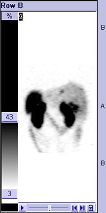 Obr. č. 9: Tomografická scintigrafie jater 24 hod. po aplikaci OctreoScanu.