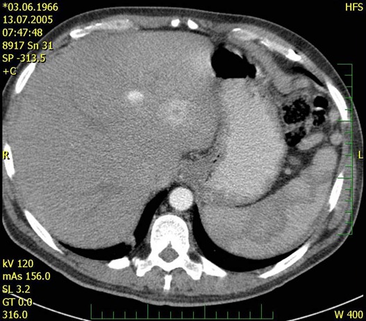 Obr. . 1 : CT bicha  pseudocystoid v jaternm hilu