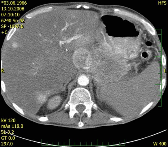 Obr. . 2 : CT bicha  tumor tla a ocasu pankreatu