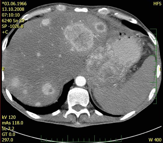 Obr. . 3 : CT bicha  mnohoetn metastzy jater