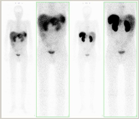 Obr. . 4 : Celotlov scintigrafie v pedn a zadn projekci 24 hod po aplikaci