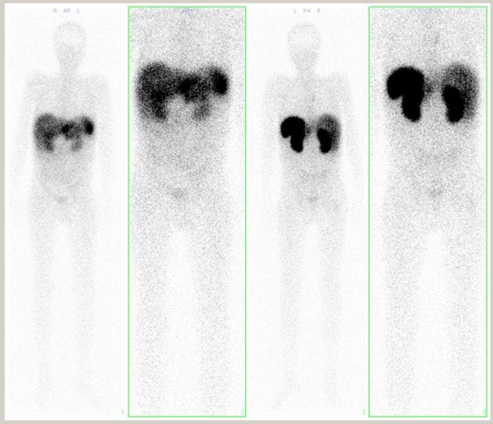 Obr. . 5 : Celotlov scintigrafie v pedn a zadn projekci 48 hod po aplikaci