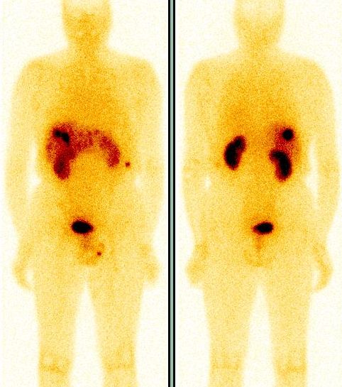 Obr. 1. Celotlov scintigrafie s 111In-pentetreotidem (OctreoScan)