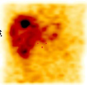 Obr. 2. SPECT jater, koronrn ez. Metastzy karcinoidu v jtrech