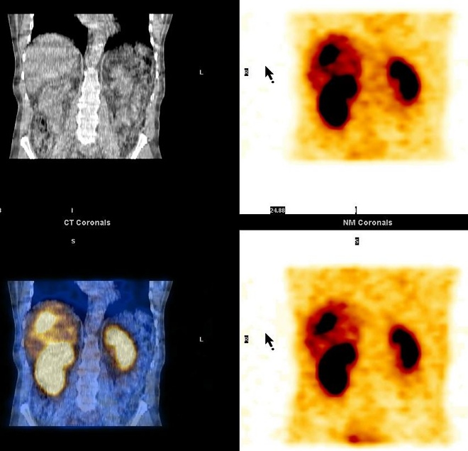 Obr. 5. SPECT, CT, SPECT/CT jater, koronrn ez, metastzy karcinoidu v jtrech