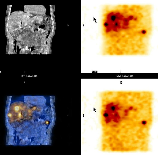 Obr. 9. SPECT, CT, SPECT/CT dutiny bin, koronrn ez