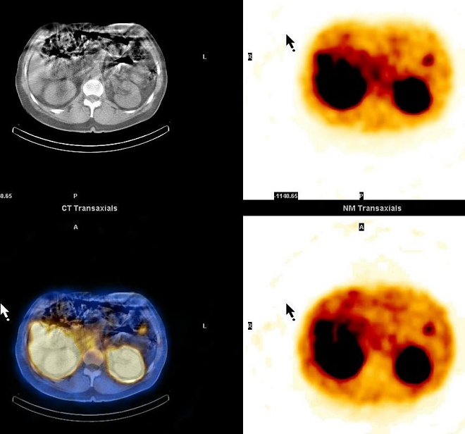 Obr. 13. SPECT, CT, SPECT/CT dutiny bin, transverzln ez, metastza v epigastriu vlevo