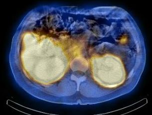 Obr. 16. SPECT/CT dutiny bin, fze obraz, transverzln ez