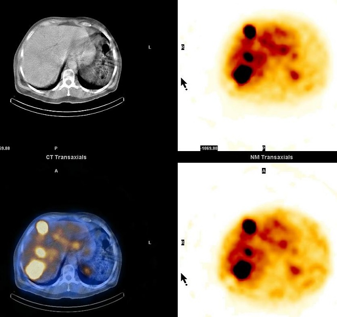 Obr. 17. SPECT, CT, SPECT/CT jater, transverzln ez, metastzy karcinoidu v jtrech