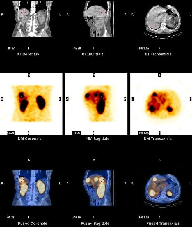 Obr. 28. CT, SPECT, SPECT/CT jater, koronrn, transverzln a sagitln ezy