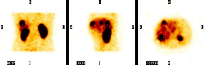 Obr. 30.  SPECT jater, koronrn, transverzln a sagitln ezy