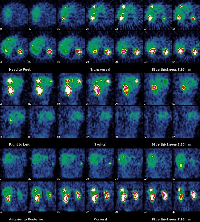 Obr. 21. SPECT dutiny bin, koronrn, transverzln a sagitln ezy