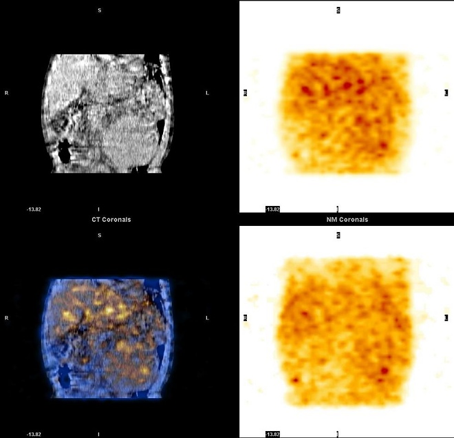 Obr. 2. SPECT, CT, SPECT/CT dutiny bin, koronrn ez