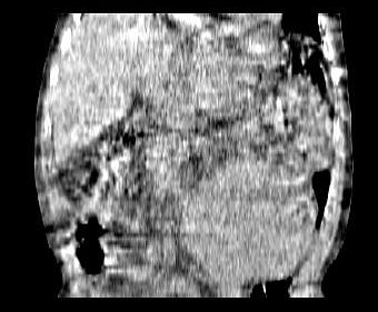 Obr. 4. CT dutiny bin, koronrn ez