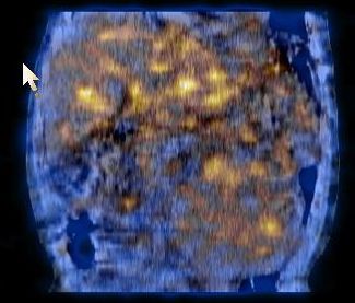 Obr. 5. SPECT/CT dutiny bin, koronrn ez