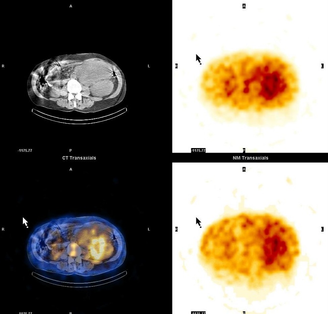 Obr. 6. SPECT, CT, SPECT/CT dutiny bin, transverzln ez