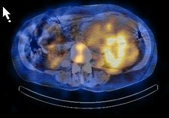 Obr. 9. SPECT/CT dutiny bin, fze obraz, transverzln ez