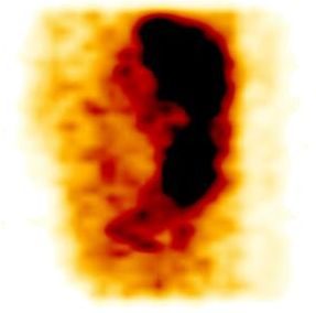 Obr. 10. SPECT dutiny bin, sagitln ez