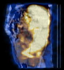 Obr. 12. SPECT/CT dutiny bin, fze obraz, sagitln ez