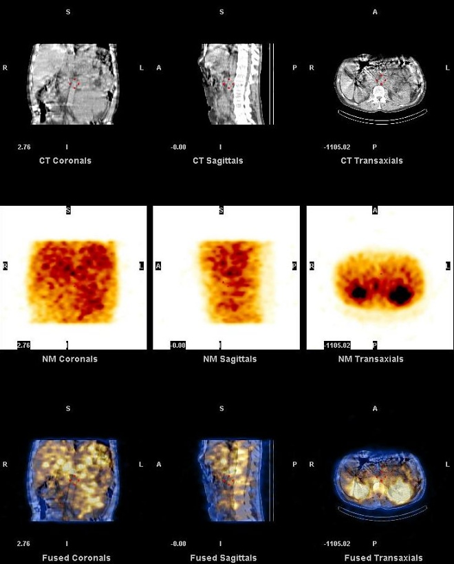 Obr. 13. SPECT, CT, SPECT/CT dutiny bin, koronrn, sagitln, transverzln ezy