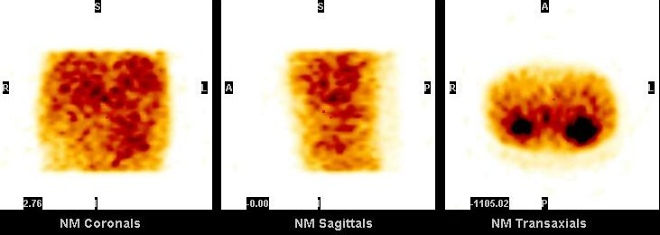 Obr. 15. SPECT dutiny bin, koronrn, sagitln, transverzln ezy