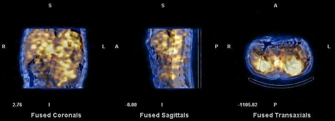 Obr. 16. SPECT/CT dutiny bin, koronrn, sagitln, transverzln ezy