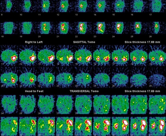 Obr. 17. SPECT dutiny bin, transverzln, koronrn, sagitln ezy