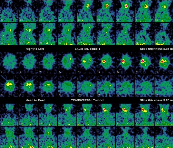 Obr. 24. SPECT dutiny hrudn a krku, transverzln, koronrn a sagitln ezy