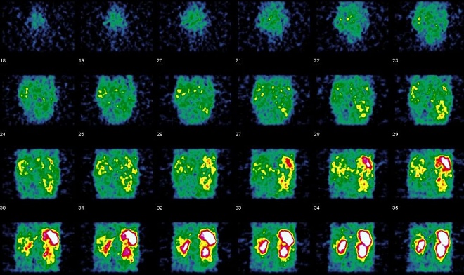 Obr. 18. SPECT dutiny bin, koronrn ezy