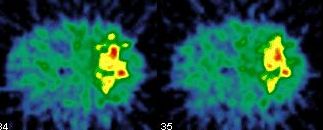 Obr. 22. SPECT dutiny bin, transverzln ezy