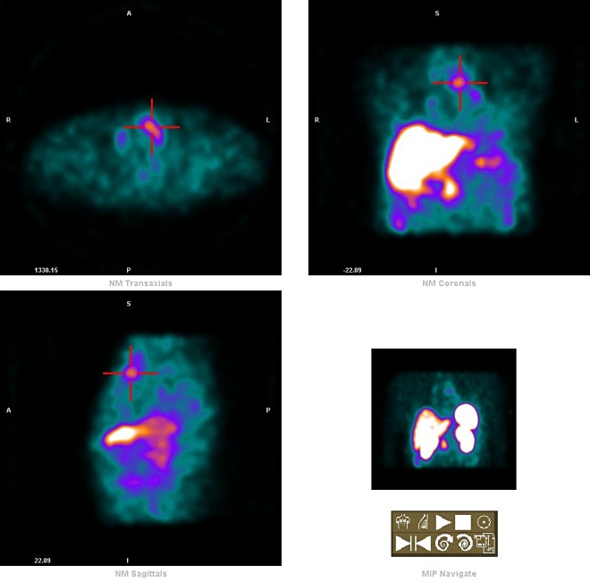 Obr. 1. mediastinum - SPECT