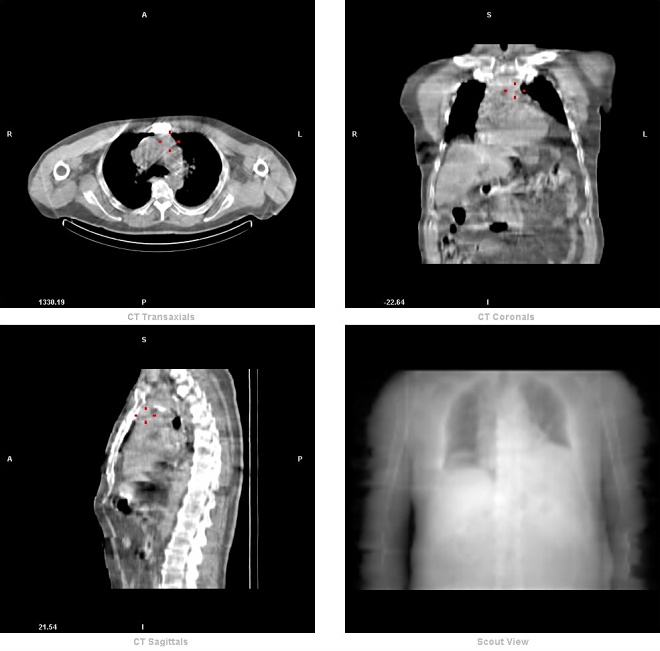 Obr. 2. mediastinum - CT