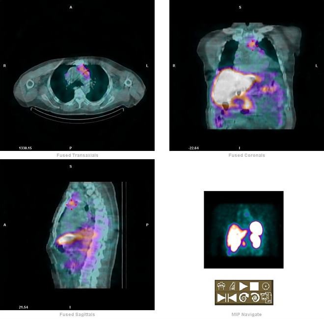 Obr. 3. mediastinum - fuse SPECT-CT