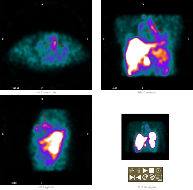 Obr. 4. paratracheln LU - SPECT