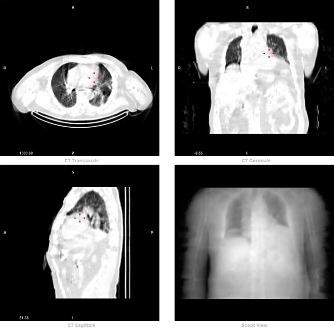 Obr. 5. paratracheln LU - CT