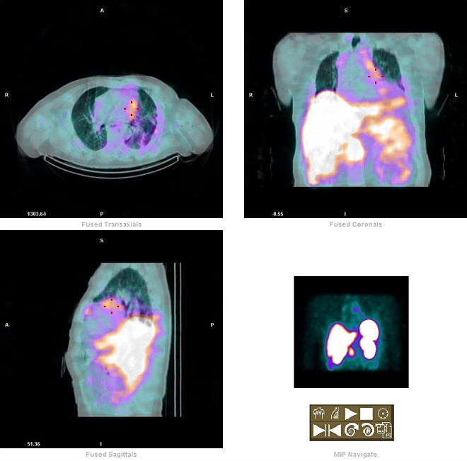 Obr. 6. paratracheální LU - fuse SPECT-CT