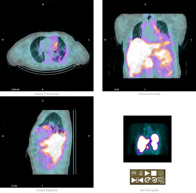 Obr. 6. paratracheln LU - fuse SPECT-CT