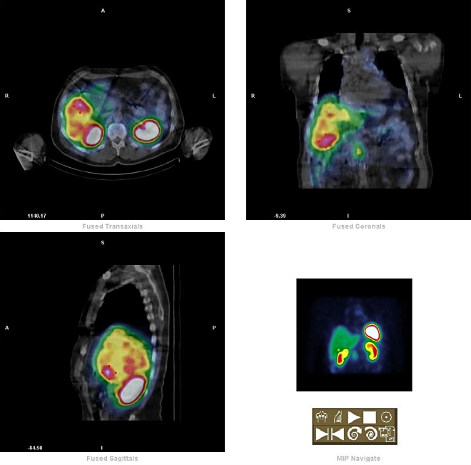 Obr. 12. hepar. - pankreas - fuse SPECT-CT