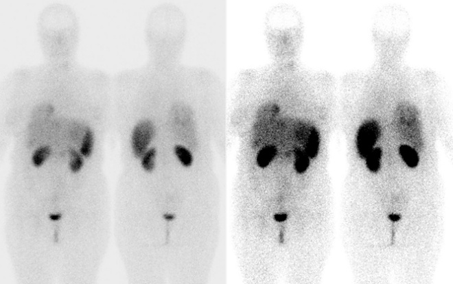 Obr.1: Celotlov scintigrafie v pedn a zadn projekci 4 hod. po aplikaci OctreoScanu.