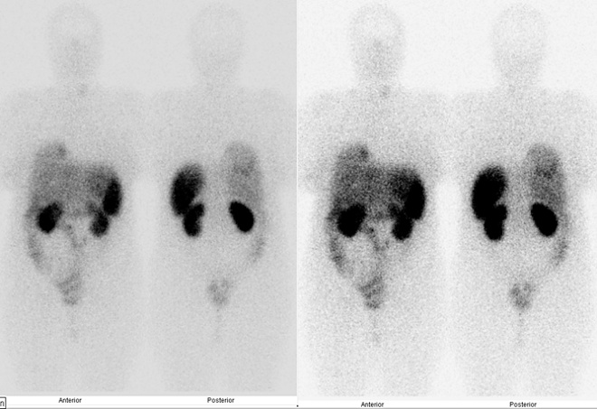 Obr. 3: Celotlov scintigrafie v pedn a zadn projekci 24 hod. po aplikaci OctreoScanu